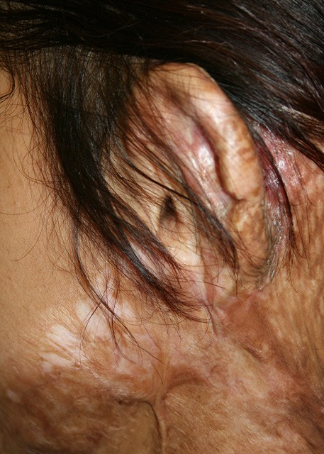 after facial reconstruction of ear