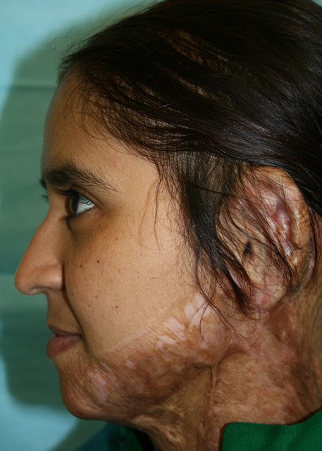 after ear reconstruction female patient left profile view