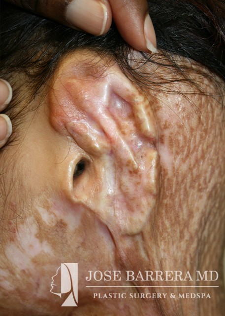before facial reconstruction of ear