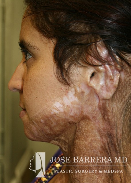 before ear reconstruction female patient left profile view