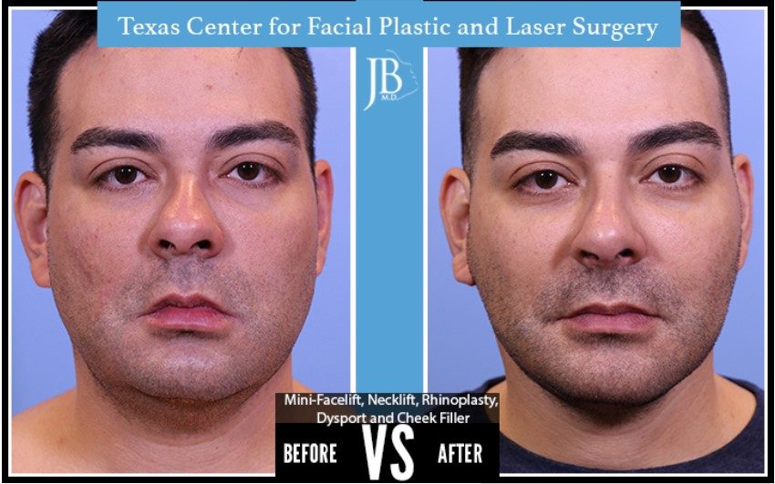 Face lift without surgery